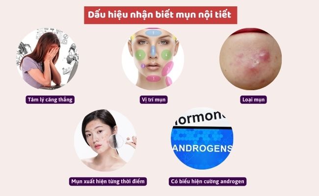DẤU HIỆU NHẬN BIẾT MỤN NỘI TIẾT Ở PHỤ NỮ TRONG ĐỘ TUỔI DẬY THÌ